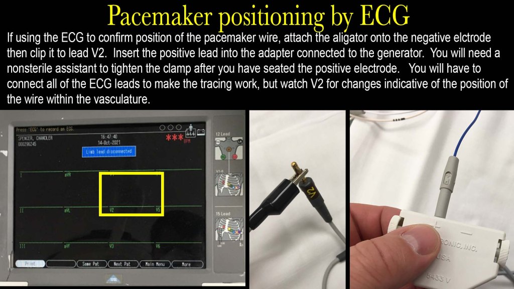 Transvenous Pacemaker | Searcy EM