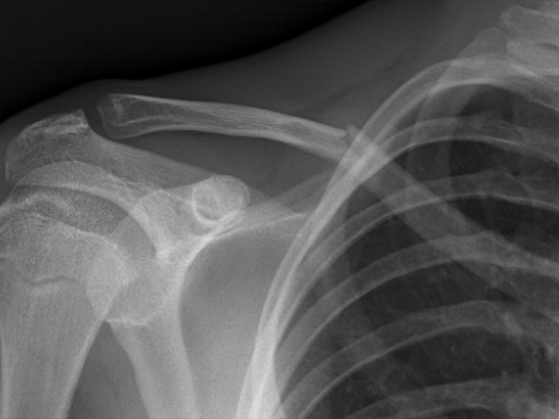 X-rays or Ultrasounds for fractures? | Searcy EM