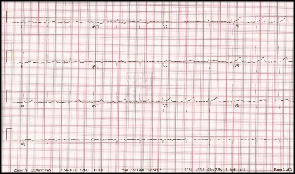 Right Axis Deviation | Searcy EM
